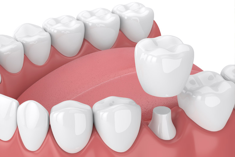 Dental Crowns in Moscow