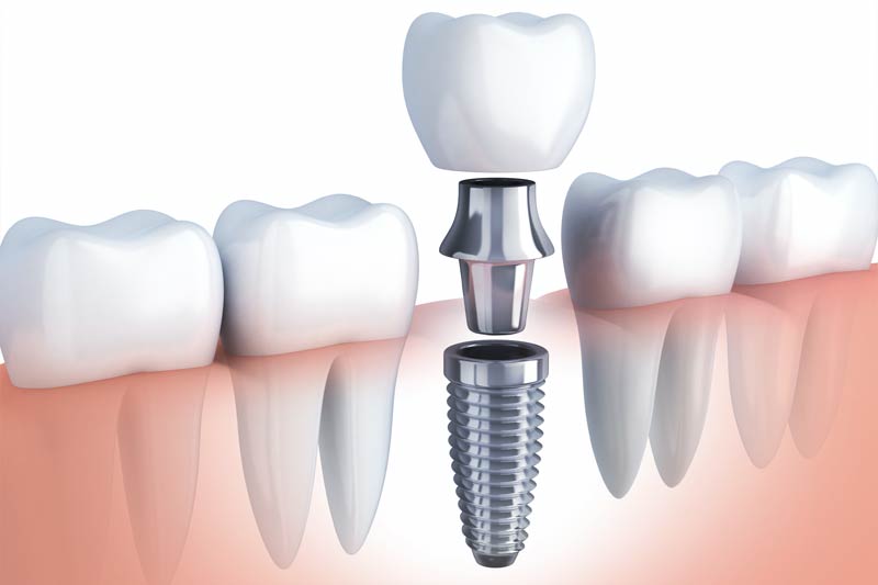 Implants Dentist in Moscow
