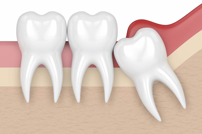 Wisdom Tooth Removal in Moscow